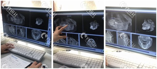 西安海涛口腔医院—拍摄口腔CT片图