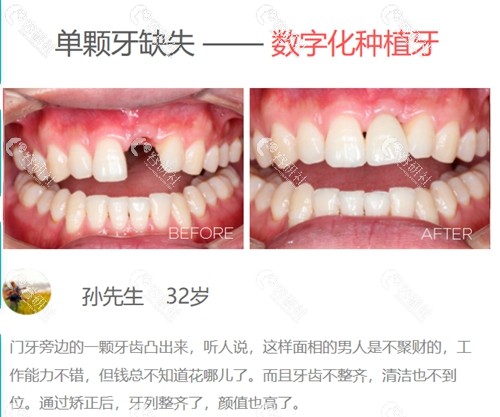 郑州华西口腔牙齿种植案例