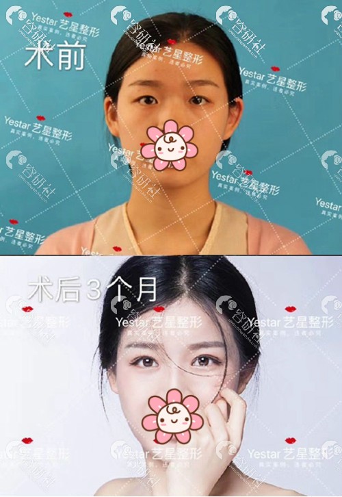 杭州艺星医疗美容医院杨连华美杜莎眼综合术前术后对比