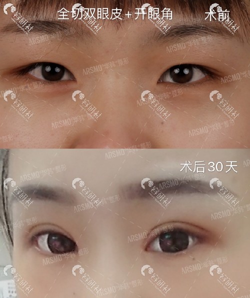 北京华韩医疗美容医院谢立宁双眼皮术前术后对比照