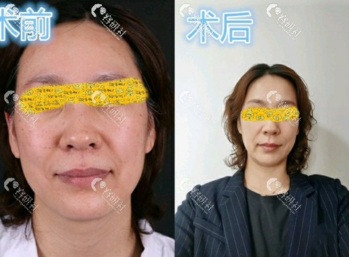 杭州时光医疗美容医院刘耿皮秒激光前后对比图