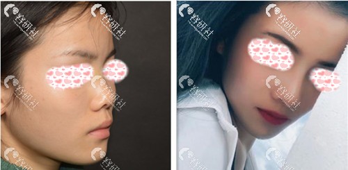 北京柏丽医疗美容门诊部李劲良鼻综合前后对比图