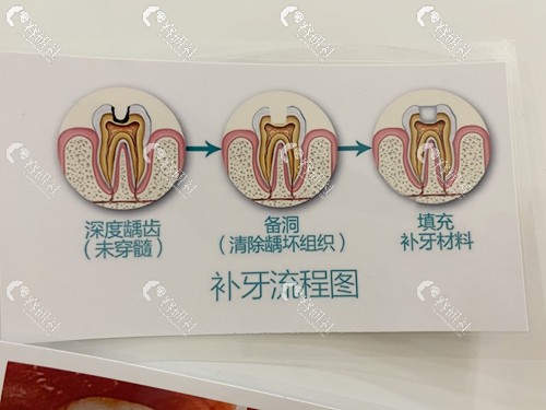 西安小白兔口腔医院补牙流程图