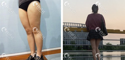 杭州格莱美医疗美容医院彭涛微创吸脂瘦大腿案例