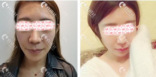 北京清木医疗美容诊所马梅生脸部自体脂肪填充日记