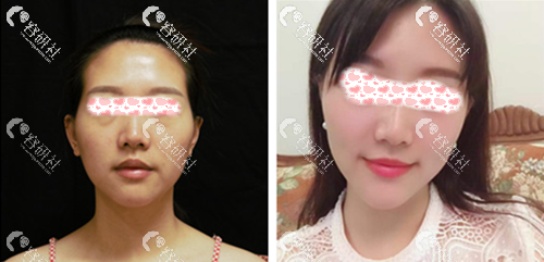 深圳美莱医疗美容医院黄海龙玻尿酸丰太阳穴案例
