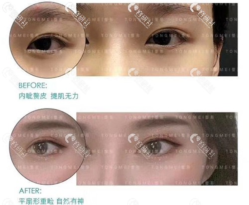 北京彤美双眼皮手术案例