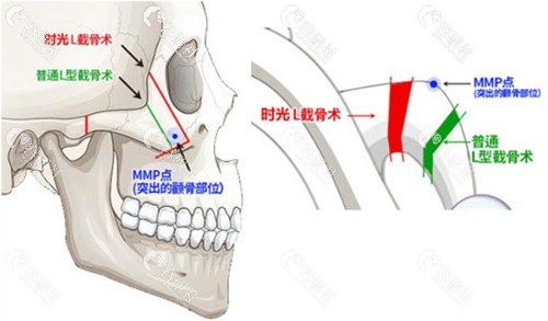 上海时光整形外科医院L截骨与普通截骨有何不同