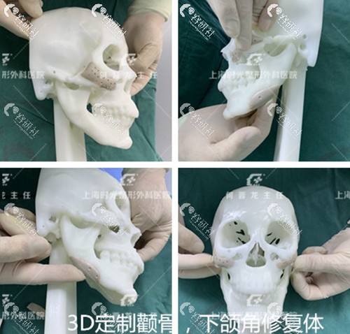 上海时光3D定制颧骨、下颌角修复体