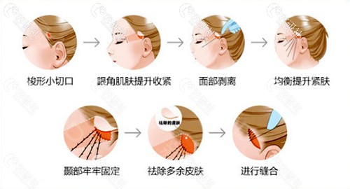 上海馥兰朵医疗美容医院陈超群小切口除皱提升手术过程