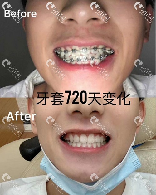 广州地区牙齿矫正术后效果照片分享