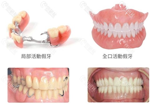 假牙都有哪些分类