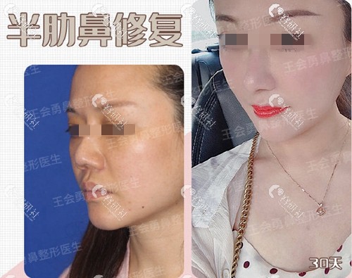 上海喜美王会勇半肋鼻修复术前术后对比照