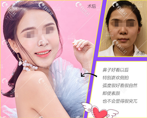 深圳美莱梁晓健隆鼻术后