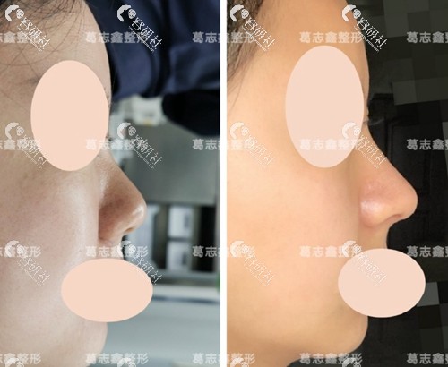 上海知颜医疗美容门诊部隆鼻术前术后对比