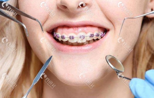 儿童牙齿固定矫正器