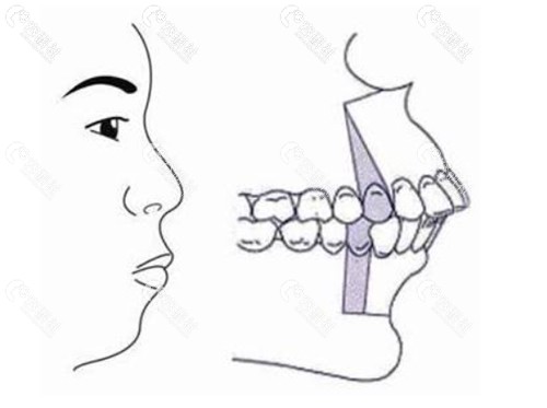 骨性和牙性凸嘴的区别