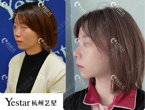 杭州艺星张龙隆鼻术前术后对比