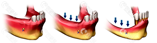 牙龈萎缩造成牙骨量流失示意图