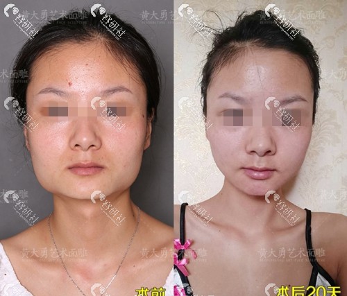 北京圣嘉荣医疗美容医院下颌角手术日记