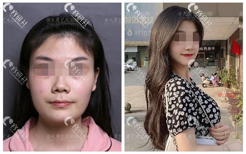 北京圣嘉荣医疗美容医院下颌角术前术后对比照
