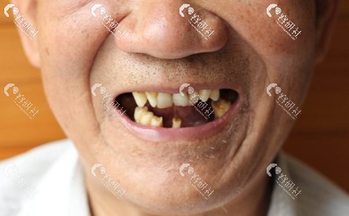 牙齿缺失问题如何改善