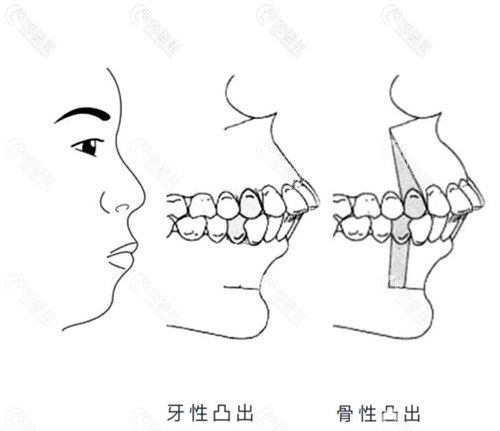 骨性和牙性凸嘴的不同