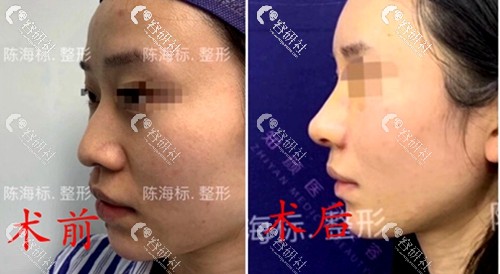 上海知颜陈海标医生肋骨隆鼻术前术后对比