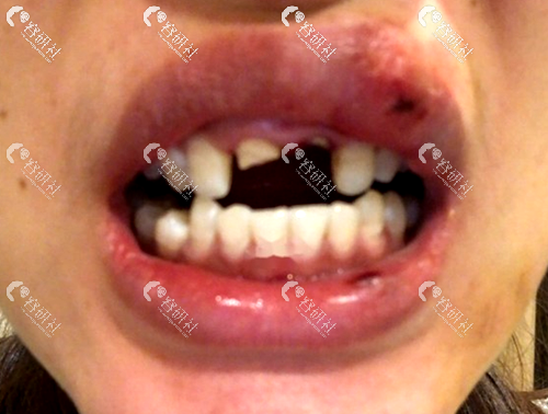 上牙齿断裂缺失的两颗牙