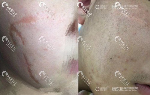 杨东运医生面部伤口疤痕修复效果照片