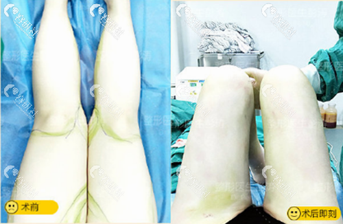 杭州格莱美彭涛医生大腿吸脂术前术后对比照