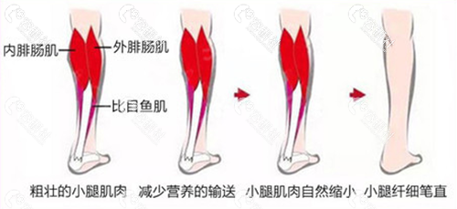 小腿肌肉重塑手术原理
