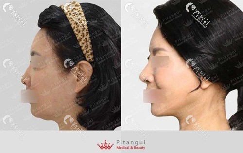 韩国pitangui必当归整形外科下颌线改善效果图