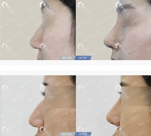 韩国pitangui必当归整形外科驼峰鼻矫正矫正效果对比图