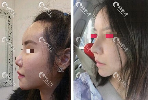 在韩国珠儿丽做高难度鼻修复术前术后对比