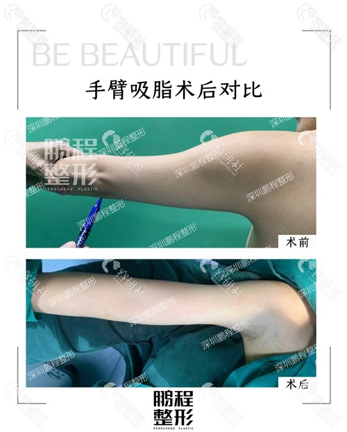 深圳鹏程医疗美容医院手臂吸脂术后对比