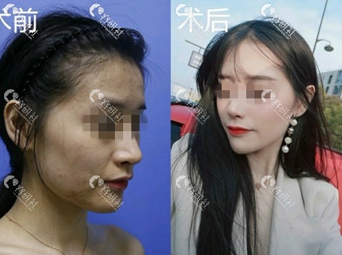 杭州时光陈小平医生下颌角整形术前术后对比照