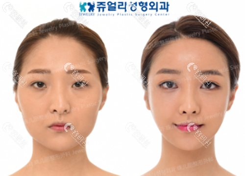 韩国珠儿丽面部填充术前术后对比照