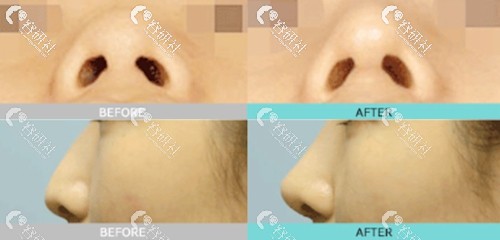 韩国珠儿丽整形外科医院自体软骨鼻尖塑形效果