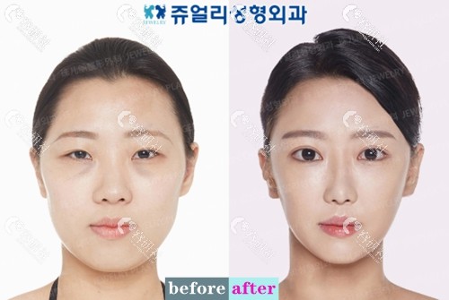 韩国珠儿丽整形外科医院鼻综合整形案例