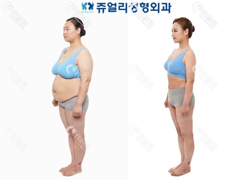 韩国珠儿丽医院做腹部吸脂日记