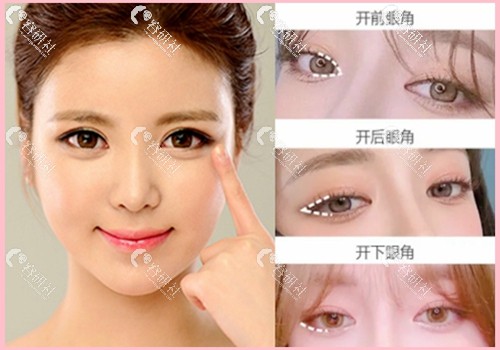韩国珠儿丽立体开眼角手术包含三个部位