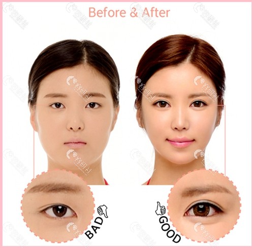 韩国珠儿丽全方位开眼角手术前后对比图
