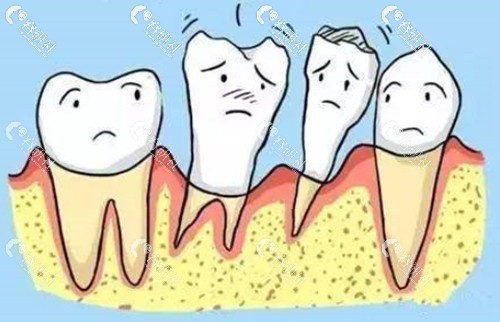 牙周病导致牙齿松动