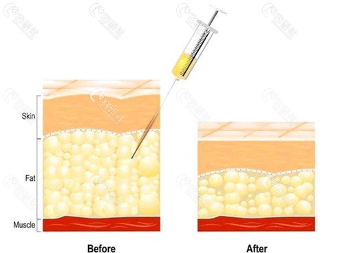 吸脂手术原理