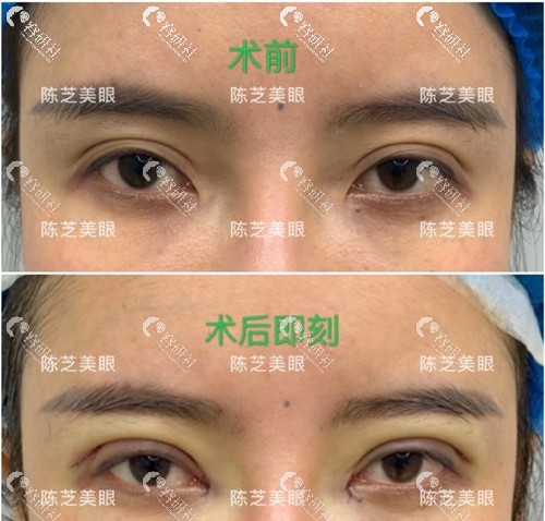 深圳明莱陈芝医生双眼皮修复 术前术后对比照
