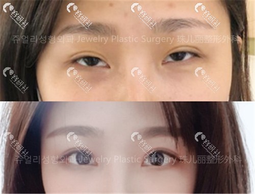 韩国珠儿丽双眼皮修复术前术后对比