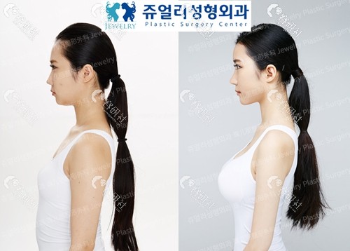 韩国珠儿丽做假体隆胸案例