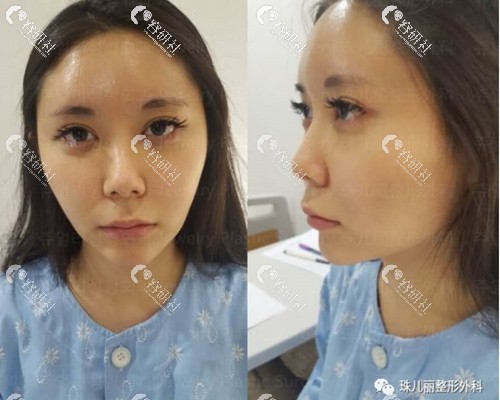 韩国珠儿丽医院做隆鼻手术前