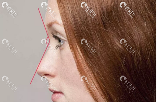 驼峰鼻鼻额角分析图